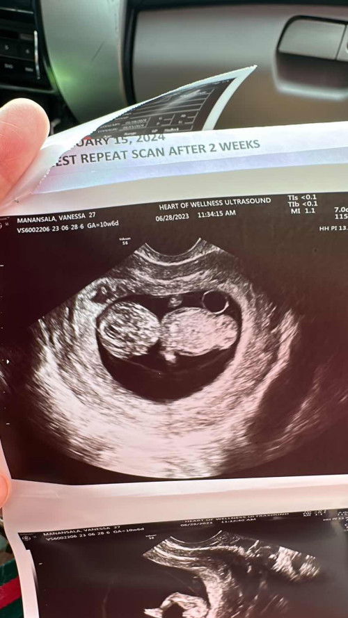 Slightly Thickened Nuchal Fold as per OB