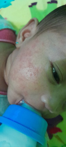 Ada yang tau gk bun salep/obat buat beruntusan kaya gini😭 usia baby 2bln tolong buat bunda² yg tau