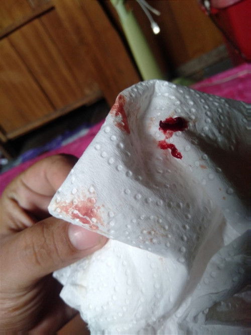 เลือดออก 36สัปดาห์