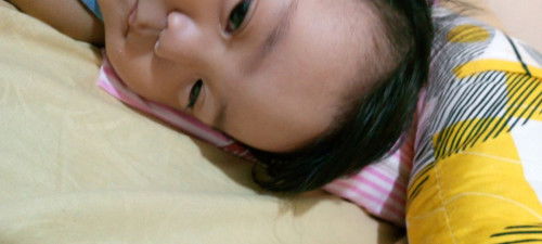 Pahabang bukol sa Noo