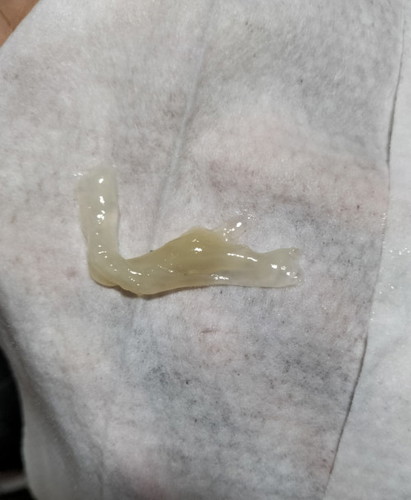 Is this Mucus plug?