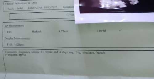 Ask lang po sana ako if okay lang po ang result ng CAS ko? With result from 11 wks,21wks and CAS