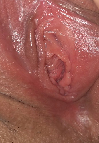 Genital Warts