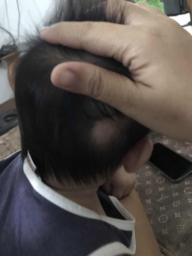 Baldspot in hair
