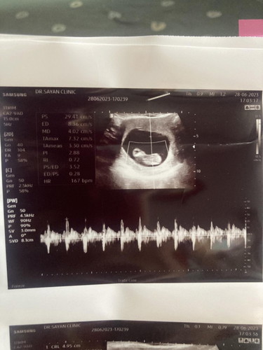 แม่ๆบ้านไหนเคยผ่านแท้งคุกคามมาแล้วบ้าง แนะนำหน่อยค่ะ