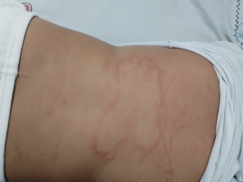 Skin rashes ?
