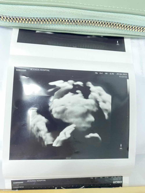 ฝากครรภ์+อัลตราซาวด์ครั้งแรก21+5w