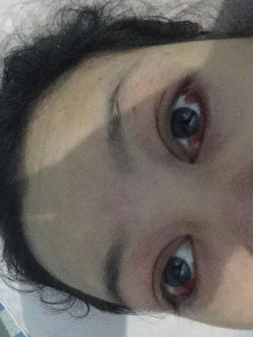 mata merah stelah melahirkan