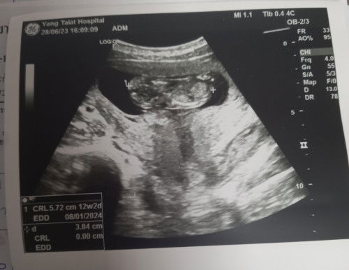 ท้องในวัยเรียน