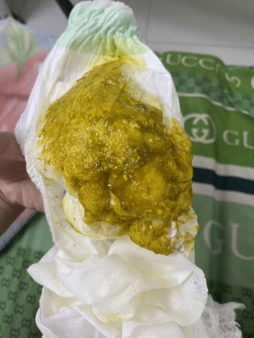 Co đi phân như vậy có bị sạo các mom. Con ti mẹ hoàn toàn. Bé 3.5 tháng