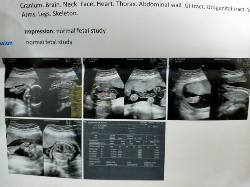 ฝากรพ.รัฐ หมอไม่ยอมบอกเพศลูก ท้องได้ 21w4d มีภาพซาวด์รูปไหนบอกเพศลูกมั้ยค่ะ