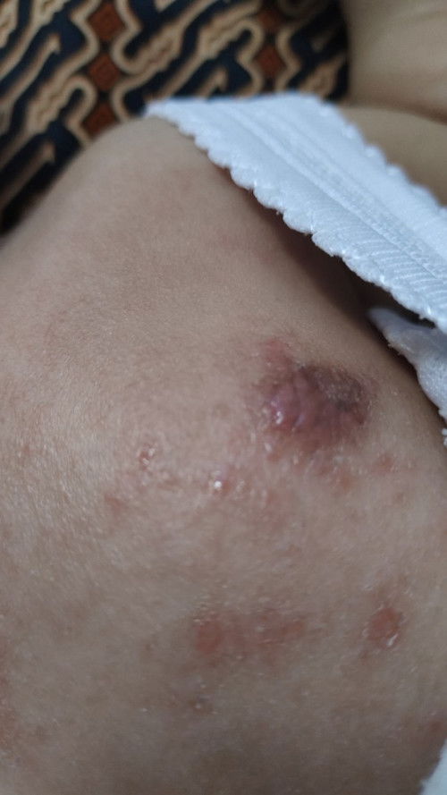 Bayiku 2,5bln, ruam di perut bruntusan sampai luka berair sperti herpes