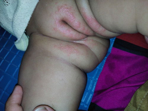 bintik kemerahan pada kemaluan bayi