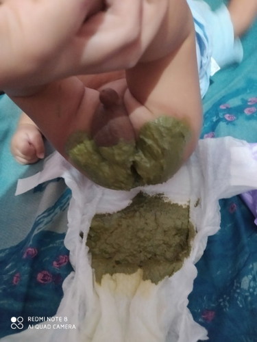 Bun maaf agak jorok, saya mau tanya ini pup anak saya umur 2bulan asi+sufor normalkah bun?