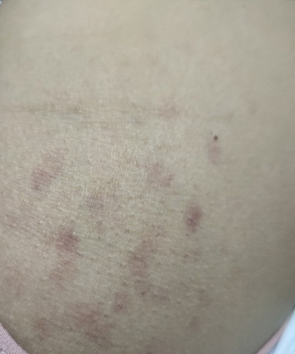 PUPP rashes