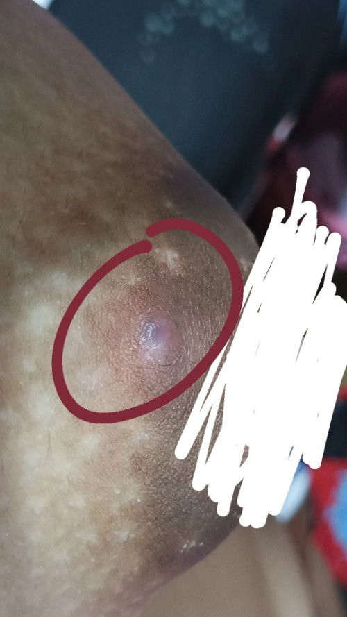 Pigsa or pimples sa nipple area?