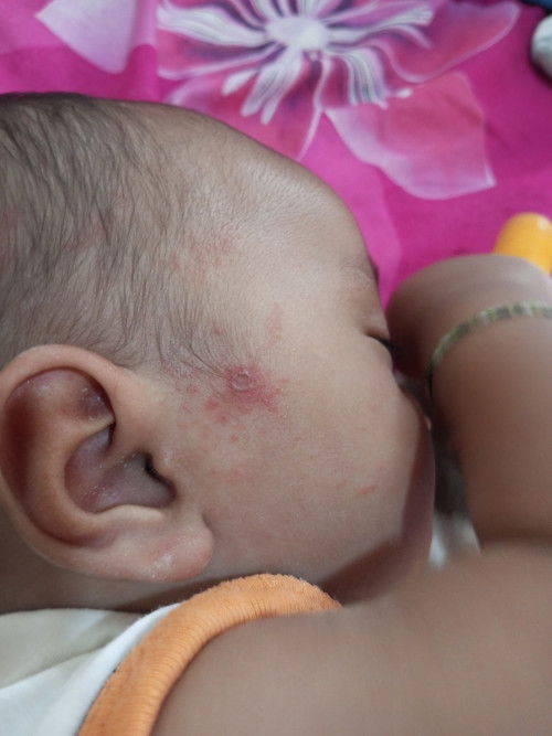 Ini tdi periksa ktny ibuny slh mkn jd ankny alergi.. selain dkasi salp in d apain ya Bun biar kring?