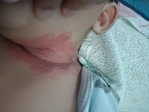 Ubat yg sesuai untuk ruam di leher baby 5 bulan..sy pakai lotion snow white...br 2 kali sapuan..
