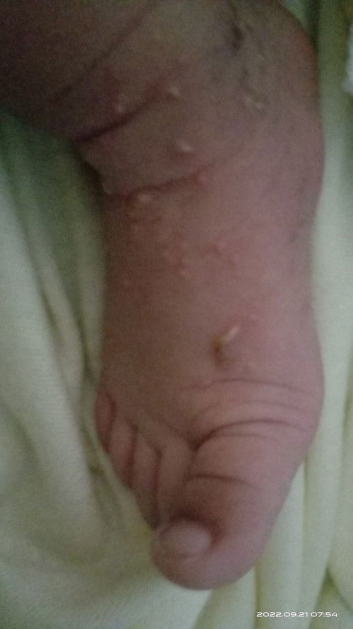 Bayi muncul bintik-bintik berair begini. Gimana nyembuhinnya ya Bun. Pakai apa ?