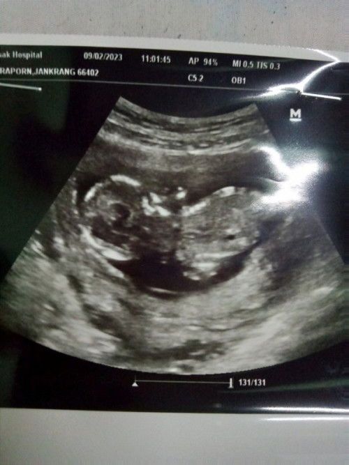 ต้าวเด็กสมบูรณ์ 34 วีค แล้วครับบ ❤️