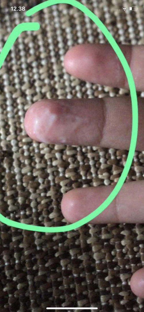 Keputihan gak gatal gak bauk