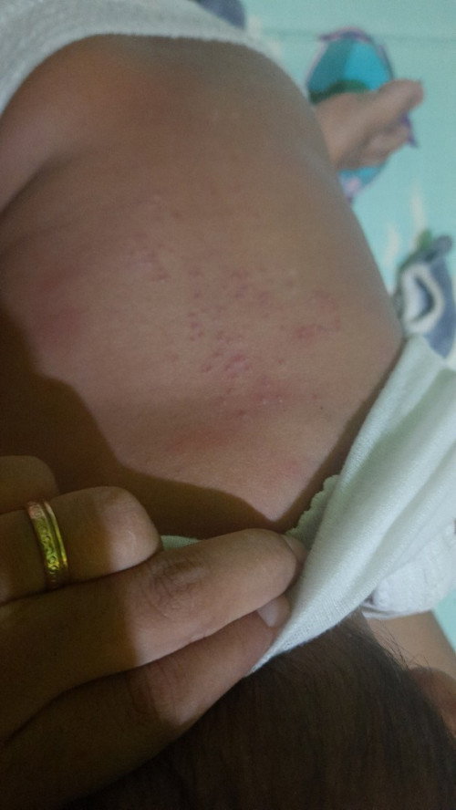 Beruntusan pada bayi