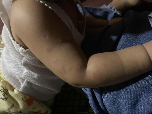 Timbul ruam2 diwajah dan kaki tangan