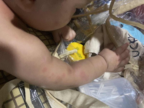 Ruam2 merah diwajah kaki dan tangan ..