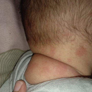 Merah2 di leher belakang bayi