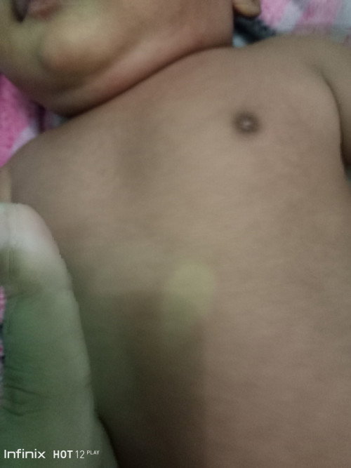 Kuning pada bayi