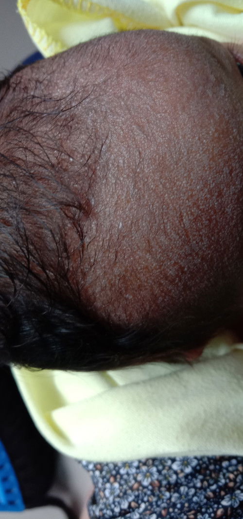 Ada benjolan seperti nanah