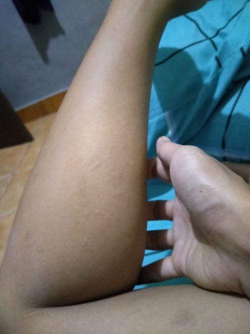 Gatal saat malam hari di kaki