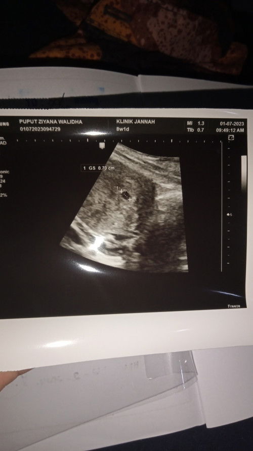 Usia janin tidak sesuai dengan usia hpht