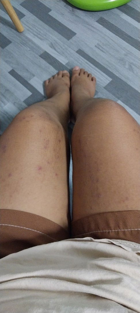 เป็นผื่นคันตามขาตามเเขนกันบ้างมั้ยคะ