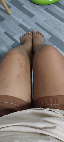 เป็นผื่นคันตามขาตามเเขนกันบ้างมั้ยคะ