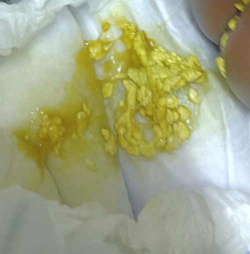 Worried about Baby poo