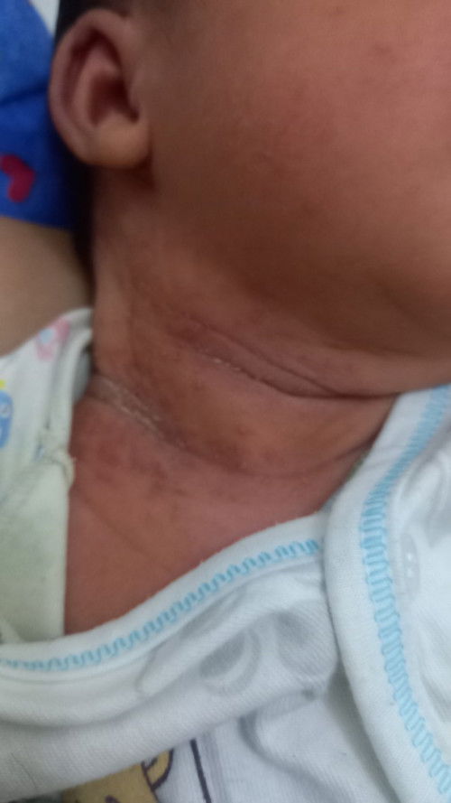 beruntusan merah basah bau