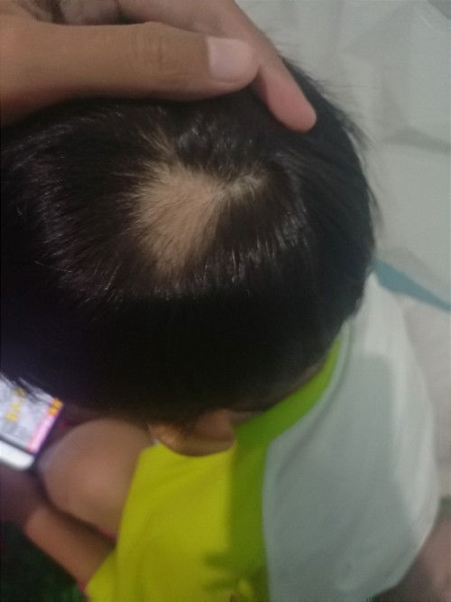 Rambut rontok pada anak