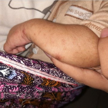 Bintik bintik sebadan