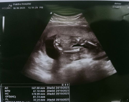 ดูเพศให้หน่อยค่ะ หมอบอกผู้หญิงแต่ในภาพเหมือนมีไข่เลยค่ะรบกวนแม่ๆดูให้หน่ิยค่ะอยากได้ผู้หญิง