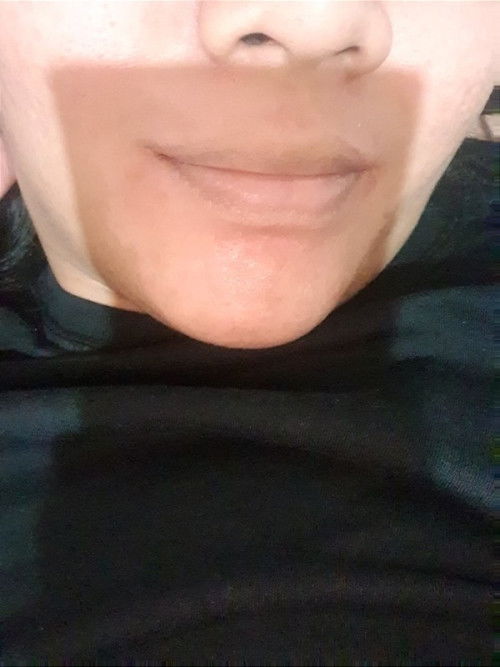 Kulit daerah dagu mengelupas dan berubah warna