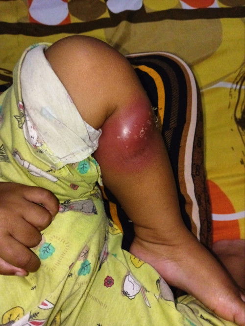 Bisul Pada kaki anak