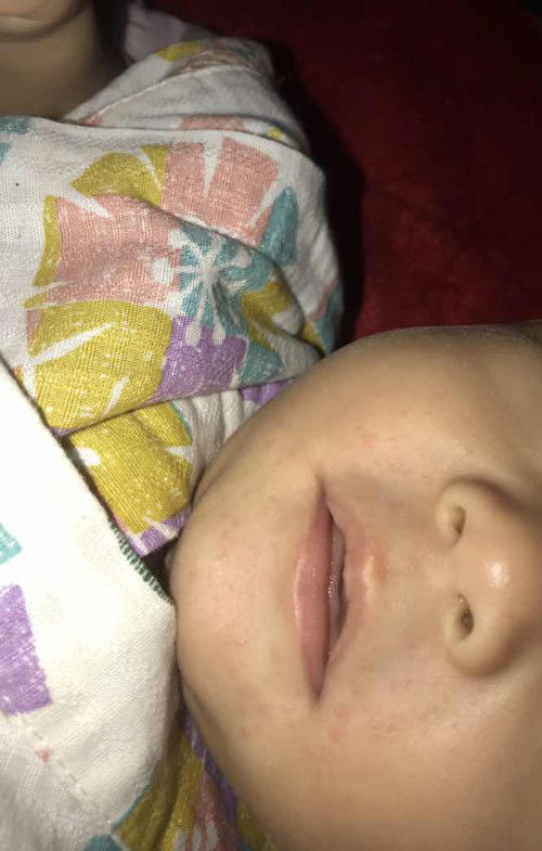 Bintik merah disekitar mulut bayi