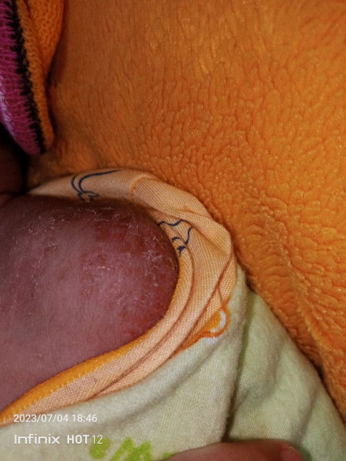 Kemerahan mengelupas pada kulit bayi
