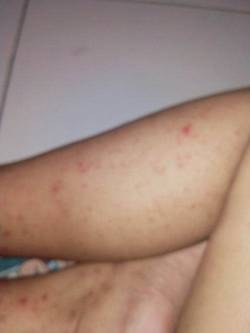 Moms pas hamil ada yg gatal kaya begini ga ya