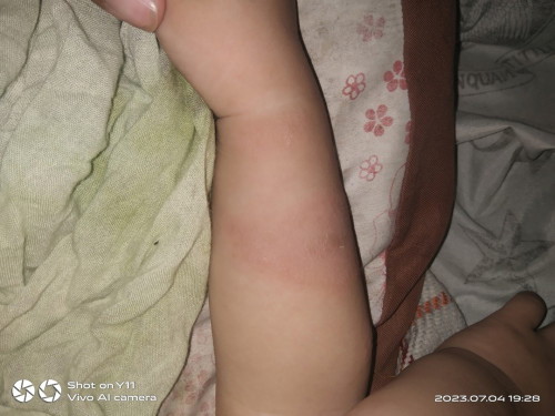 Skin disease ano pong pangalan nito at gamot sa ganto