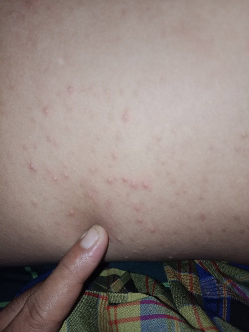 Gatal bintik bintik