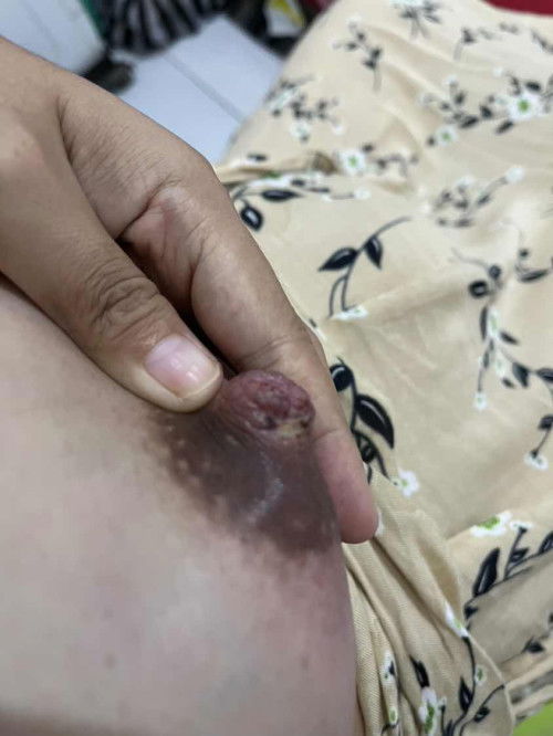 Obat untuk puting lecet