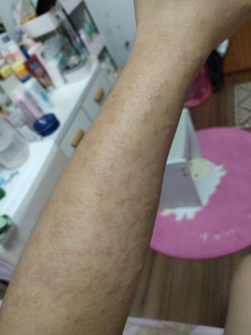 ผื่นคันขึ้นตามตัว