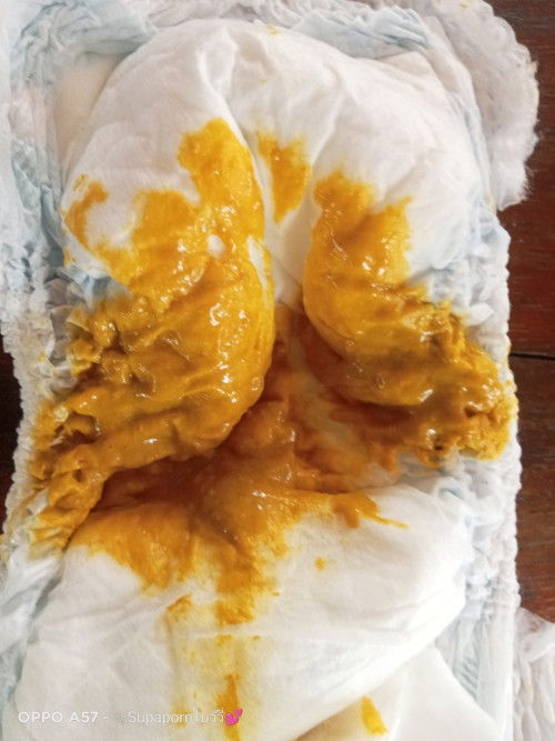 สีอุจจาระของเด็กนมแม่+นมผง